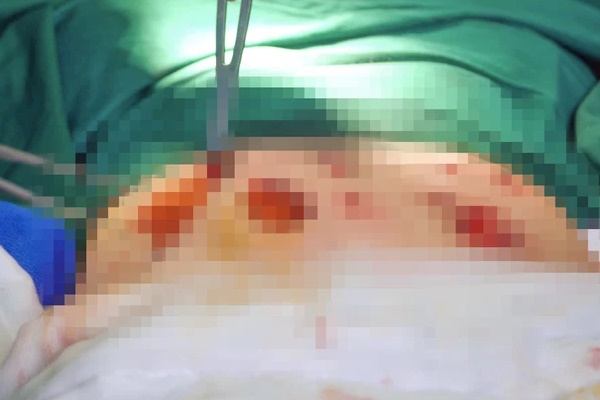 Tiêm thuốc tan mỡ giá 70 triệu đồng, người phụ nữ thủng 15 lỗ trên bụng-1
