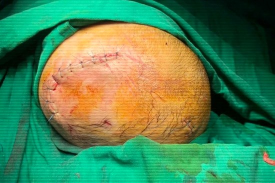 Bé 6 tháng tuổi bị chó cưng cắn xuyên sọ, đây là 10 lưu ý 