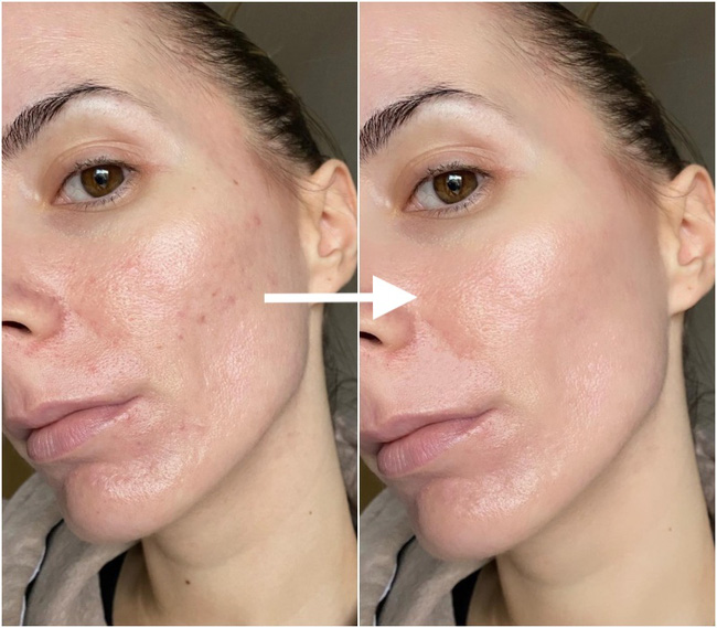 Hóa ra Vitamin C sẽ nhân đôi hiệu quả trị thâm nám, tàn nhang... khi kết đôi với thành phần này-1