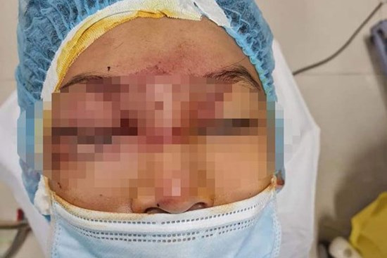 Mẹ bơm xe bị nổ lốp, mảnh vỡ làm hỏng mắt con trai