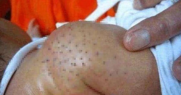 Nhờ mẹ chồng chăm sóc cháu, con dâu tá hỏa phát hiện trên người em bé đầy vết chấm đen kinh sợ, bác sĩ kiểm tra mới biết nguyên nhân-1