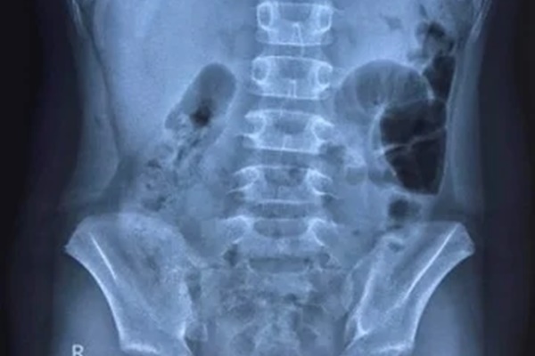 Vì sao 3 bệnh nhi ở Hải Phòng bị thủng dạ dày khi mắc Covid-19?-3