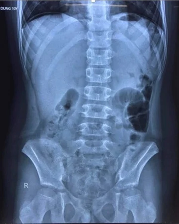 Vì sao 3 bệnh nhi ở Hải Phòng bị thủng dạ dày khi mắc Covid-19?-1