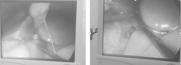 Vì sao 3 bệnh nhi ở Hải Phòng bị thủng dạ dày khi mắc Covid-19?-2