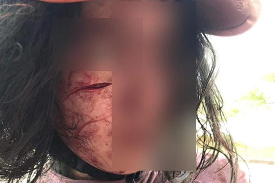Người phụ nữ bị chồng rạch mặt khi đi làm thủ tục ly hôn: Vết thương sâu 8cm, bị rạch bằng mảnh vỡ thủy tinh