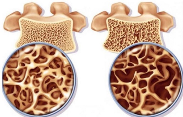 Sau tuổi 30, phụ nữ cần thường xuyên ăn 8 món để tránh mất xương dần dần, khuyến cáo 2 việc cần tránh, một việc phải làm để xương khỏe, người dẻo dai-3