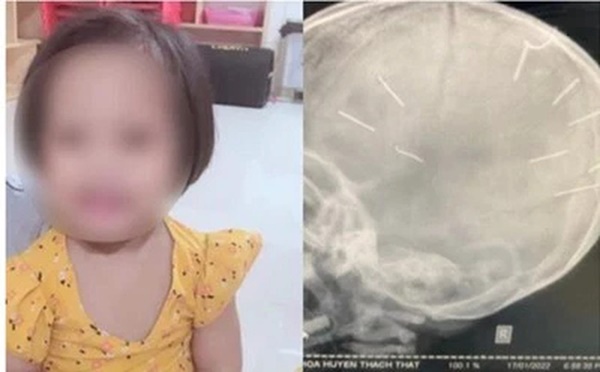 Bác sĩ BV Xanh Pôn chia sẻ về những ngày cuối đời của bé gái bị nhân tình của mẹ đóng 10 chiếc đinh vào đầu-1
