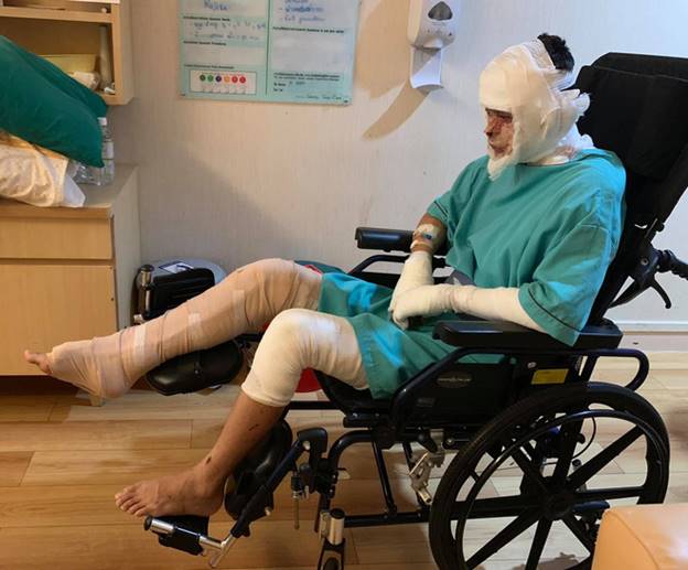 Nỗi ám ảnh kinh hoàng của Việt kiều Canada sau 3 năm bị tạt axit: Trải qua hơn 20 cuộc phẫu thuật, kẻ thủ ác vẫn nhởn nhơ nhưng có thêm niềm hạnh phúc lớn lao-4