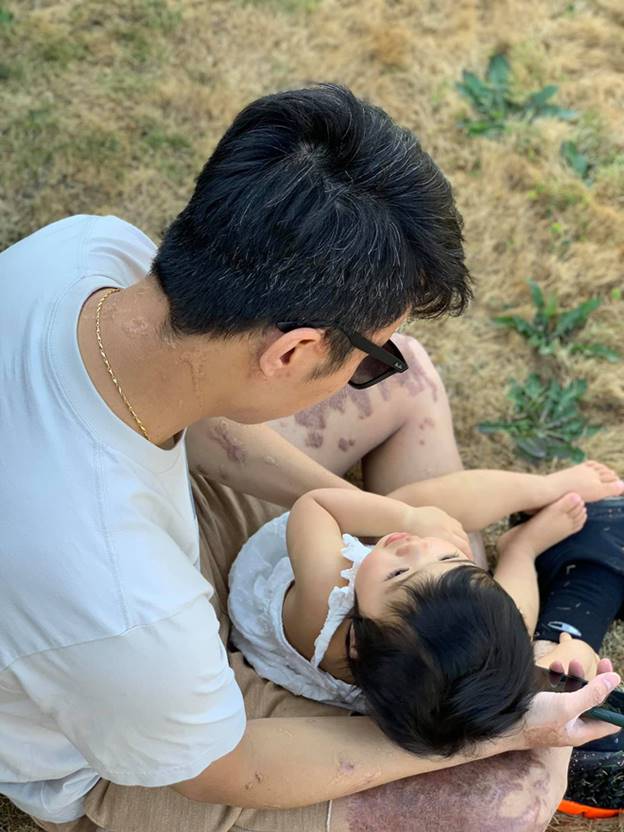 Nỗi ám ảnh kinh hoàng của Việt kiều Canada sau 3 năm bị tạt axit: Trải qua hơn 20 cuộc phẫu thuật, kẻ thủ ác vẫn nhởn nhơ nhưng có thêm niềm hạnh phúc lớn lao-8