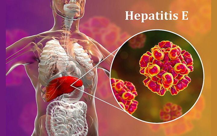 Ăn hết đĩa gan lợn xào, người đàn ông bỗng ngã vật phải nhập viện cấp cứu, biết được nguyên nhân ai cũng kinh hãi-2