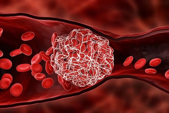 Cảnh giác với biến chứng đột quỵ hậu COVID-19