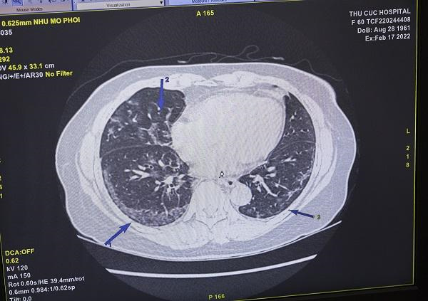 Hậu Covid-19: Tổn thương phổi khó lường phát hiện qua thăm khám-2