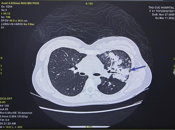 Hậu Covid-19: Tổn thương phổi khó lường phát hiện qua thăm khám-1