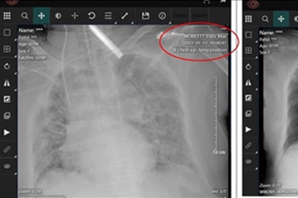 Bé gái ho ra máu, không nói được do mắc Covid-19-2