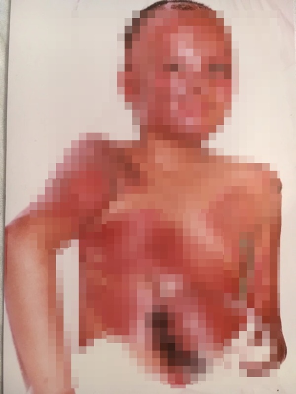 Gia đình chết thảm trong tai nạn máy bay, bé gái 10 tuổi sống sót trở về với vết bỏng biến dạng toàn thân và cái kết khó tin sau hơn 30 năm-1