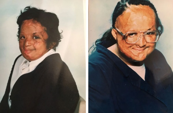 Gia đình chết thảm trong tai nạn máy bay, bé gái 10 tuổi sống sót trở về với vết bỏng biến dạng toàn thân và cái kết khó tin sau hơn 30 năm-3