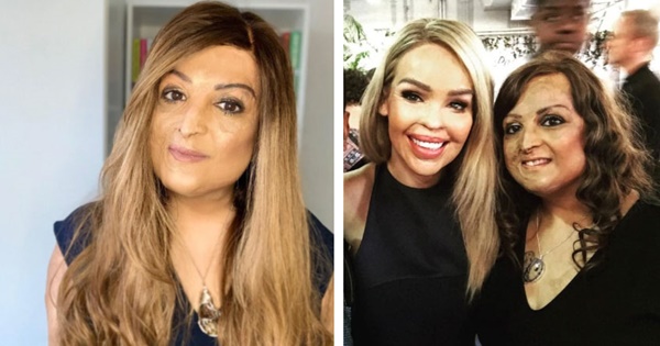 Gia đình chết thảm trong tai nạn máy bay, bé gái 10 tuổi sống sót trở về với vết bỏng biến dạng toàn thân và cái kết khó tin sau hơn 30 năm-4