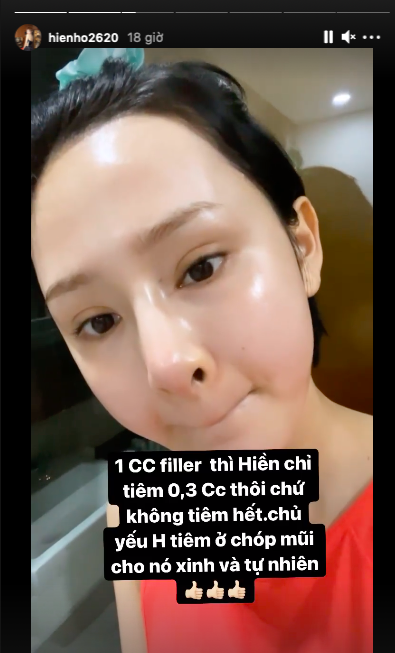 Hiền Hồ: Tiêm má baby, làm răng sứ, nâng cơ mí mắt và tiêm 0,3cc Filler vào mũi để có được nhan sắc... cứng đơ-5