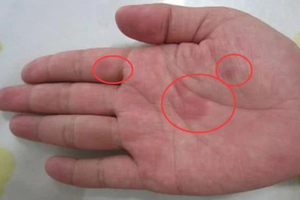 5 biểu hiện trên cơ thể cho thấy gan đang gửi tín hiệu cầu cứu, cần đi kiểm tra kịp thời, đừng để chậm trễ-3