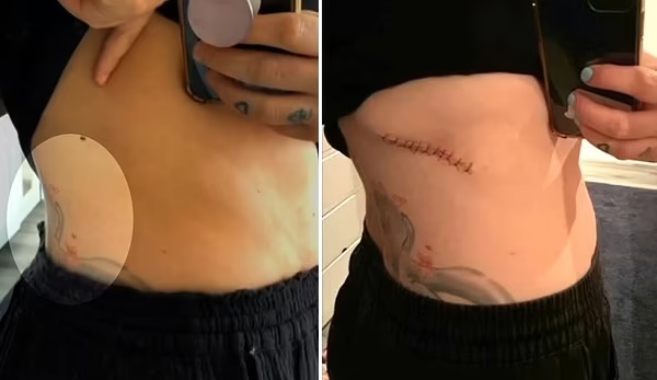 Người phụ nữ 32 tuổi phát hiện bị ung thư nhờ một chấm nhỏ sau lưng-2