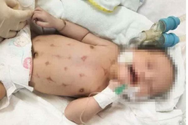 Bé sơ sinh nguy kịch sau khi nằm than, chích sài đẹn-1