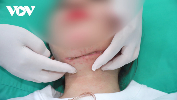 Tiêm tan mỡ nọng cằm, cô gái phải cứa cổ vì bị áp xe, hoại tử vùng cổ-2