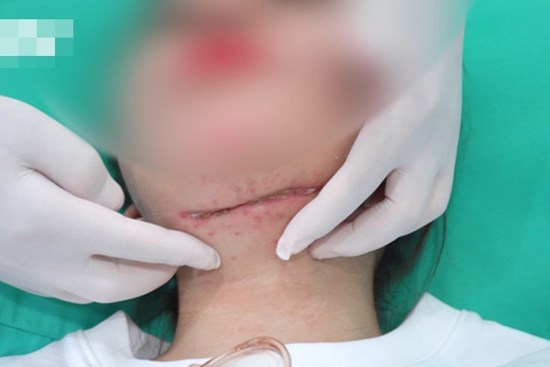 Tiêm tan mỡ nọng cằm, cô gái phải cứa cổ vì bị áp xe, hoại tử vùng cổ