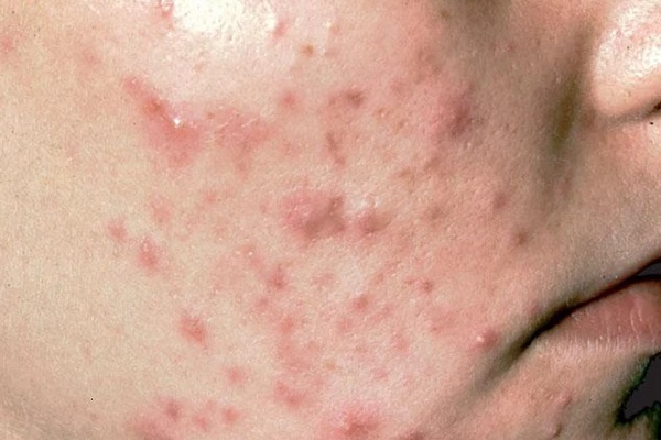 Hậu Covid-19, nhiều chị em trở nên bối rối vì mụn nổi khắp mặt: Để mụn biến mất, có 2 việc cần làm được-1