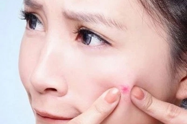 Hậu Covid-19, nhiều chị em trở nên bối rối vì mụn nổi khắp mặt: Để mụn biến mất, có 2 việc cần làm được-2