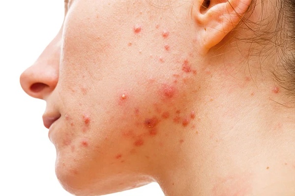 Hậu Covid-19, nhiều chị em trở nên bối rối vì mụn nổi khắp mặt: Để mụn biến mất, có 2 việc cần làm được-3