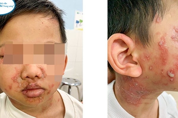 Đau rát do kiến ba khoang nhưng bị nhầm là Zona, bác sĩ chỉ cách phân biệt-1