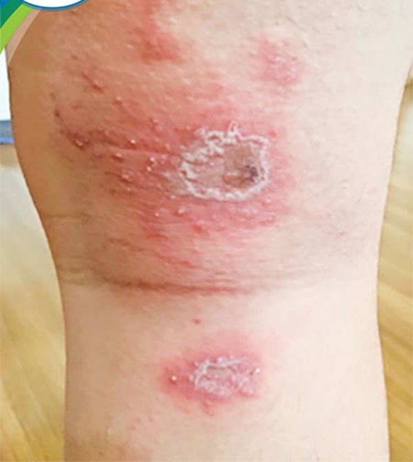 Đau rát do kiến ba khoang nhưng bị nhầm là Zona, bác sĩ chỉ cách phân biệt-2