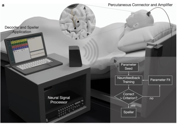 Lần đầu tiên, một người đàn ông bị nhốt hồn nói được nhờ cấy ghép chip não: Câu đầu tiên anh cảm ơn bác sĩ, sau đó thì đòi uống bia-4
