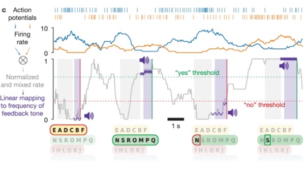 Lần đầu tiên, một người đàn ông bị nhốt hồn nói được nhờ cấy ghép chip não: Câu đầu tiên anh cảm ơn bác sĩ, sau đó thì đòi uống bia-5