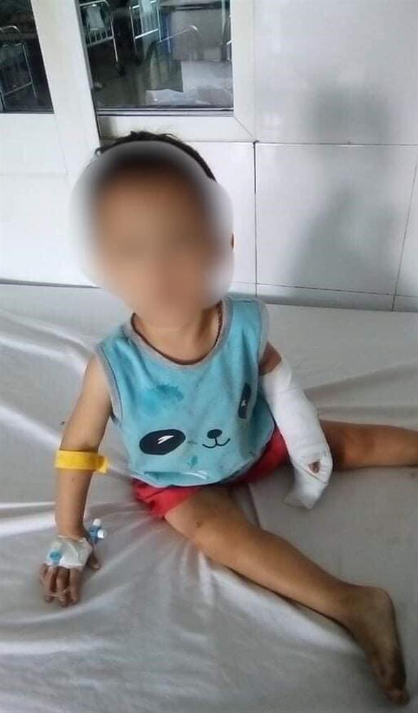 Bé gái 3 tuổi bị người tình của mẹ dùng dao lam cắt đứt gân tay-2