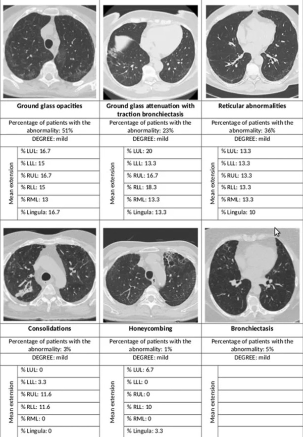 Hình ảnh phổi của bệnh nhân sau một năm khỏi Covid-19-1