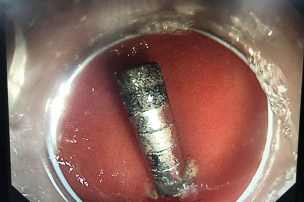 Bé trai nuốt phải dị vật này gây thủng dạ dày, thứ như vậy không nên để trẻ chơi-1