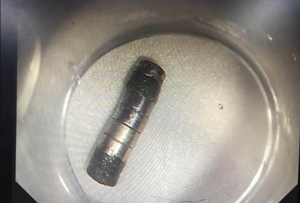 Bé trai nuốt phải dị vật này gây thủng dạ dày, thứ như vậy không nên để trẻ chơi-2