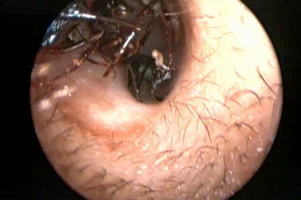 Đang ngủ thì bọ chui vào tai, bạn sẽ làm gì? Bác sĩ lời khuyên 1 việc tuyệt đối không làm nếu không muốn hỏng tai-1