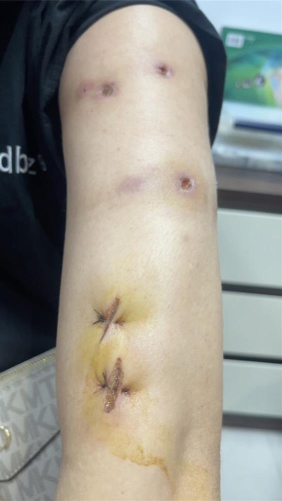 Người phụ nữ vào viện với 30 lỗ thủng trên người-1