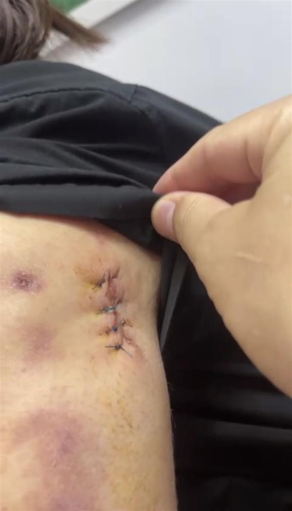 Người phụ nữ vào viện với 30 lỗ thủng trên người-2