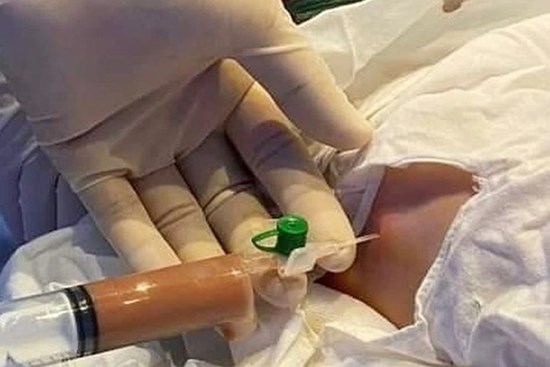 Bé 28 ngày tuổi mắc COVID-19 diễn tiến nặng