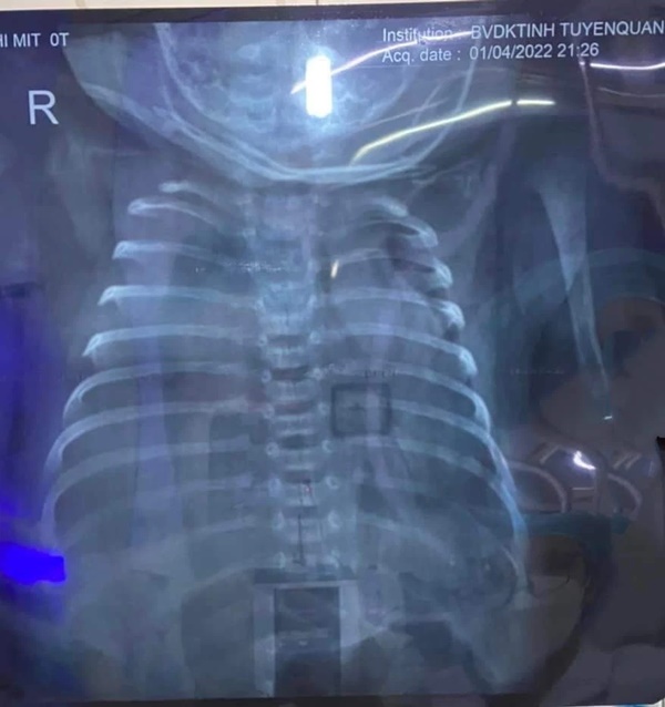 Bé 28 ngày tuổi mắc COVID-19 diễn tiến nặng-2