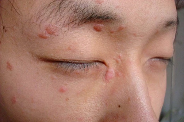 Chàng trai 27 tuổi bỗng mọc mụn khắp mặt, không ngờ nhiễm virus HPV chỉ vì 1 hành động nhỏ trong khách sạn khi đi công tác-2
