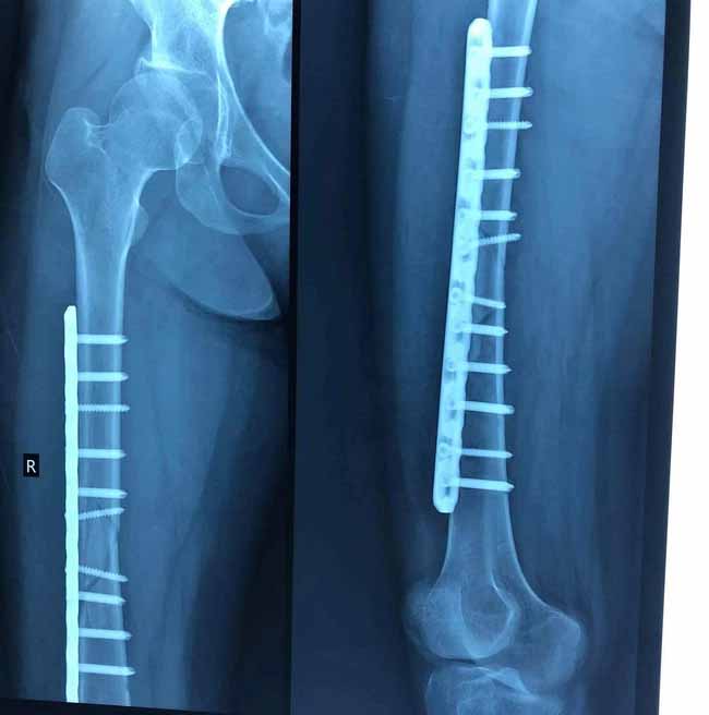 Vụ người phụ nữ khuyết tật bị gãy xương đùi khi trị liệu ở Hà Nội: Đã có kết quả giám định-3