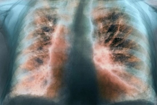 Ai dễ bị xơ phổi hậu Covid-19?