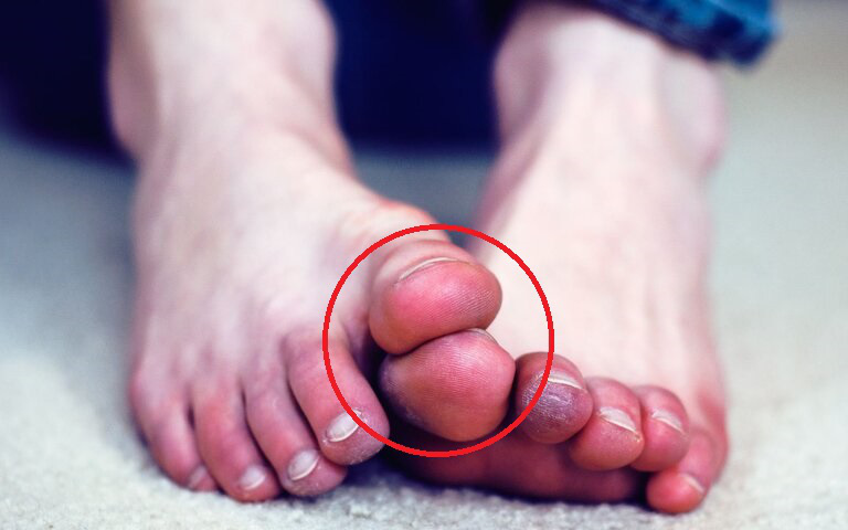 Cô gái 27 tuổi bị cắt cụt chân vì bệnh tiểu đường, bác sĩ tiếc nuối nói 2 dấu hiệu ở chân rõ như thế vẫn lười không đi viện sớm-1