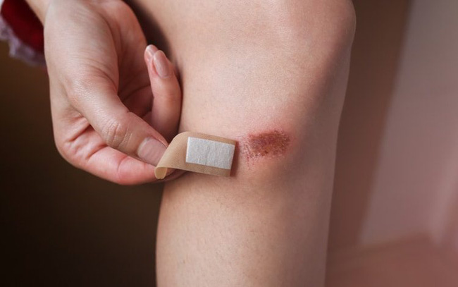 Cô gái 27 tuổi bị cắt cụt chân vì bệnh tiểu đường, bác sĩ tiếc nuối nói 2 dấu hiệu ở chân rõ như thế vẫn lười không đi viện sớm-5