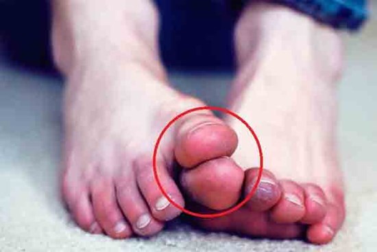 Cô gái 27 tuổi bị cắt cụt chân vì bệnh tiểu đường, bác sĩ tiếc nuối nói 
