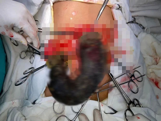 Bé gái vô cớ đau dạ dày, bác sĩ phẫu thuật khẩn cấp lôi ra từ bụng dị vật đáng sợ, nguyên nhân chỉ từ 1 thói quen tưởng vô hại-1